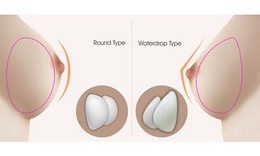 C&#243; n&#234;n ti&#234;m filler ngực kh&#244;ng?