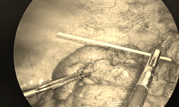 Người đàn ông thủng đại tràng vì vô ý ngậm tăm khi ngủ