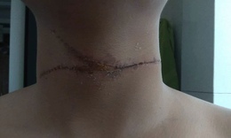 Dây diều cứa cổ người đi đường, chém rách cản trước xe ô tô