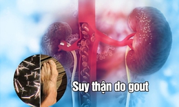Suy thận do gout - Những điều bạn cần biết