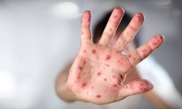 Ca mắc tay ch&#226;n miệng ở Ninh Thuận tăng hơn 10 lần so với năm ngo&#225;i