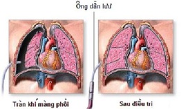 Tr&#224;n kh&#237; m&#224;ng phổi ở những người h&#250;t thuốc l&#225;