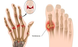 Acid uric bao nhi&#234;u l&#224; mắc bệnh gout?