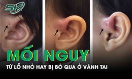 Mối nguy từ lỗ nhỏ hay bị bỏ qua ở v&#224;nh tai