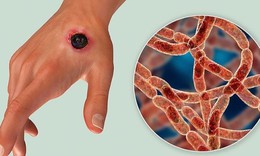 Khi có vết thương hở, nếu bắt buộc phải tiếp xúc với đất nước bị ô nhiễm, cần phải làm gì?
