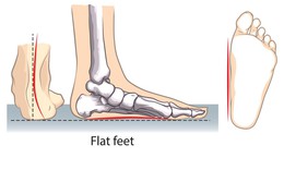 Câu hỏi thường gặp liên quan đến bàn chân bẹt