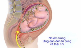 Bệnh vi&#234;m m&#224;ng ối: Nguy&#234;n nh&#226;n, triệu chứng, ph&#242;ng bệnh v&#224; c&#225;ch điều trị