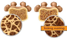 Lo&#227;ng xương, ai cần đo mật độ xương?