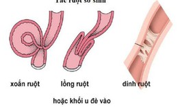 C&#226;u hỏi thường gặp li&#234;n quan đến bệnh tắc ruột sơ sinh