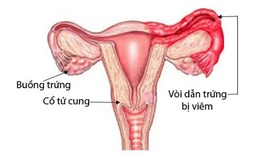 Vi&#234;m ống dẫn trứng: Nguy&#234;n nh&#226;n, triệu chứng, ph&#242;ng bệnh v&#224; c&#225;ch điều trị