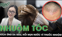 Da đầu ửng đỏ chi ch&#237;t mụn nước v&#236; dị ứng thuốc nhuộm t&#243;c