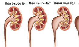 Thận ứ nước: Nguy&#234;n nh&#226;n, triệu chứng v&#224; c&#225;ch điều trị