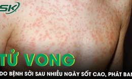 B&#233; trai 8 tuổi tử vong do bệnh sởi sau nhiều ng&#224;y sốt cao, ph&#225;t ban