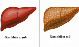 C&#226;n bằng chuyển h&#243;a – bảo vệ sức khỏe của gan