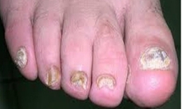 Các thuốc điều trị bệnh nấm móng