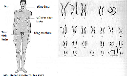 Hội chứng XYY c&#243; chữa được kh&#244;ng?