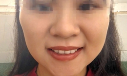 Khuôn mặt méo mó sau khi tiêm botox