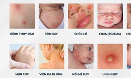 Mẩn đỏ, mụn li ti hay gặp ở trẻ sơ sinh chữa thế nào?