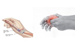 Đau cổ tay lan ra ngón cái là bệnh gì?