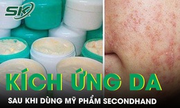 Phồng rộp m&#244;i sau khi d&#249;ng mỹ phẩm &#39;secondhand&#39;