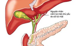 Y tế huyện cứu bệnh nh&#226;n sốc nhiễm tr&#249;ng do vi&#234;m t&#250;i mật 