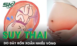 Cứu sống mẹ con sản phụ suy thai, d&#226;y rốn xoắn nhiều v&#242;ng li&#234;n tiếp v&#224; s&#225;t nhau