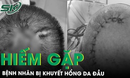 Phẫu thuật cho bệnh nh&#226;n bị tổn thương da đầu hiếm gặp