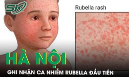 Ghi nhận ca mắc rubella đầu ti&#234;n tại H&#224; Nội trong năm 2024 