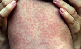 Xuất hiện ca mắc rubella đầu ti&#234;n trong năm 2024 tại H&#224; Nội