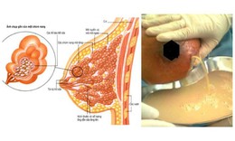 C&#225;c biện ph&#225;p điều trị &#225;p xe v&#250;