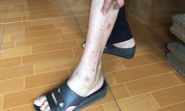 Nguyên nhân khiến hàng chục người ở Thanh Hóa nổi ngứa toàn thân