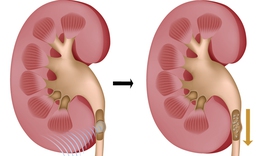8 c&#226;u hỏi thường gặp của người bệnh sỏi tiết niệu
