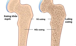 Người bị lo&#227;ng xương tập g&#236;, ki&#234;ng tập g&#236;?