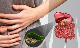 Những yếu tố làm tăng nguy cơ mắc sỏi túi mật
