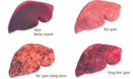 C&#225;c dấu hiệu cảnh b&#225;o ung thư gan