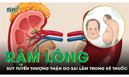 B&#233; trai 13 tuổi suy tuyến thượng thận, rậm l&#244;ng v&#236; lạm dụng thuốc