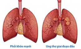 Cách tập luyện ở người mắc bệnh ung thư phổi