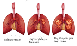 C&#225;c lựa chọn điều trị ung thư phổi