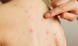 Gia tăng ca mắc sởi, hầu hết chưa ti&#234;m vaccine, TPHCM lập tổ chuy&#234;n gia điều trị