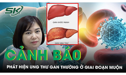 Chuy&#234;n gia cảnh b&#225;o, ung thư gan thường ph&#225;t hiện ở giai đoạn muộn