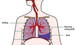 Chế độ ăn cho người bệnh tr&#224;n dịch m&#224;ng phổi