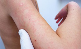 Rôm sảy: Nguyên nhân, triệu chứng, phòng ngừa và điều trị