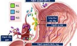 Ung thư dạ d&#224;y: Nguy&#234;n nh&#226;n, biểu hiện, c&#225;ch điều trị v&#224; ph&#242;ng bệnh