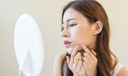 Mụn ẩn có nên nặn không?