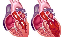 Suy tim tr&#225;i: Nguy&#234;n nh&#226;n, triệu chứng, c&#225;ch điều trị v&#224; ph&#242;ng bệnh