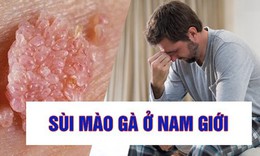 S&#249;i m&#224;o g&#224; ở nam: Dấu hiệu, nguy&#234;n nh&#226;n, c&#225;ch chữa