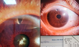 Chuyên gia HITEC giúp người bệnh đọc được sách bằng con mắt tưởng như đã mù loà