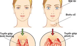 Nguy&#234;n nh&#226;n, triệu chứng của bướu tuyến gi&#225;p v&#224; biện ph&#225;p cải thiện