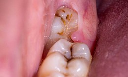 Những biến chứng có thể gặp khi nhổ răng khôn
