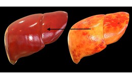 Những th&#243;i quen khiến bạn nhanh mắc gan nhiễm mỡ